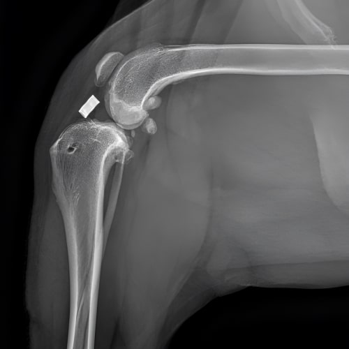 ACL Surgery